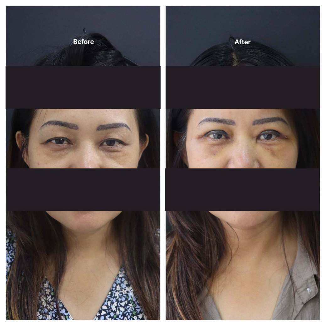 Eyelid Surgery KOQ10